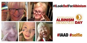 #ILookOutForAlbinism