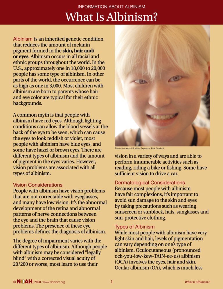 About Albinism And Hypopigmentation National Organization For peters-anomaly-hereditary-ocular-diseases